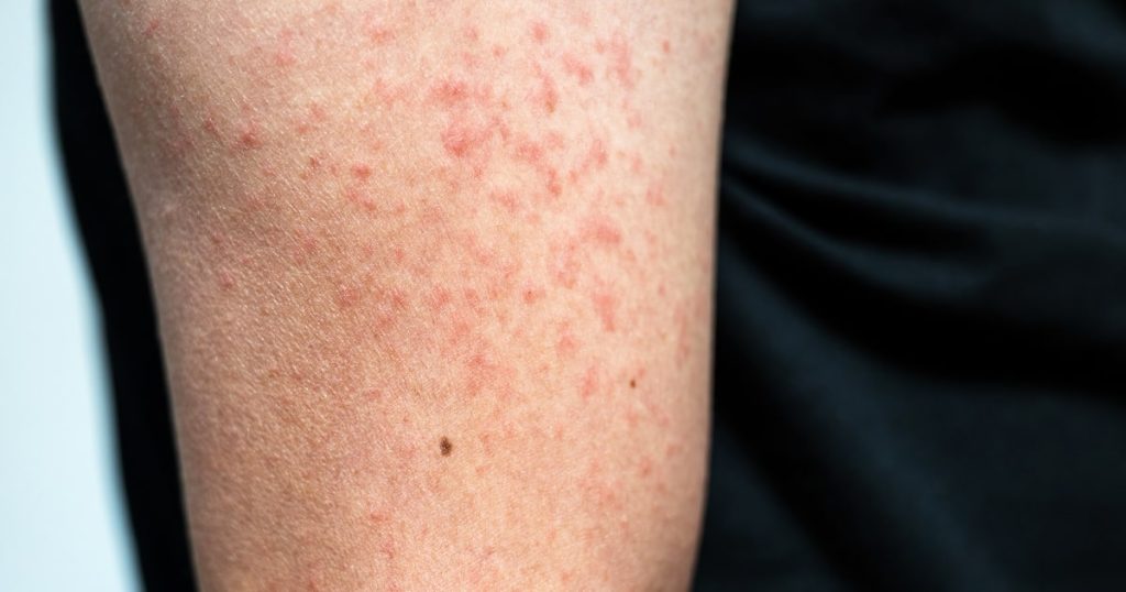 240325 Measles Rash Arm Stock Ac 603p F0c675.jpg