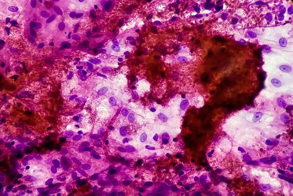 240723 Tuberculosis Se 309p 0d102e.jpg