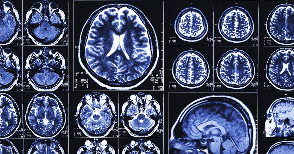 Ai Alzheimers Gettyimages 939348708 Facebook.jpg