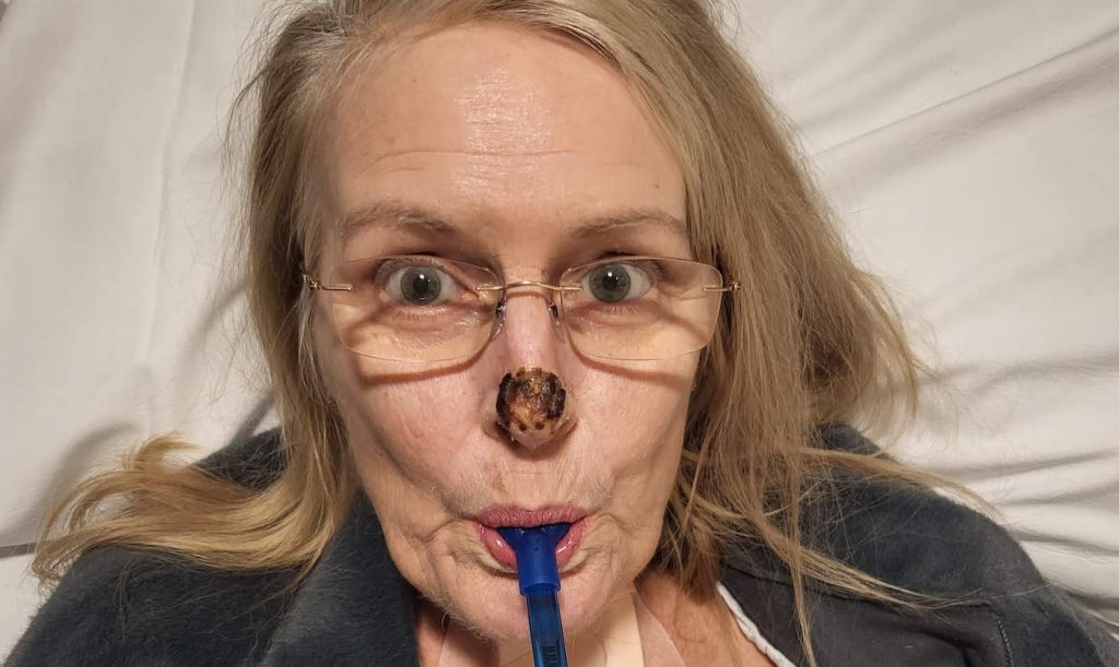 Beatrice Johnson W Flesh Eating Bacteria In Hospital Swns.jpg