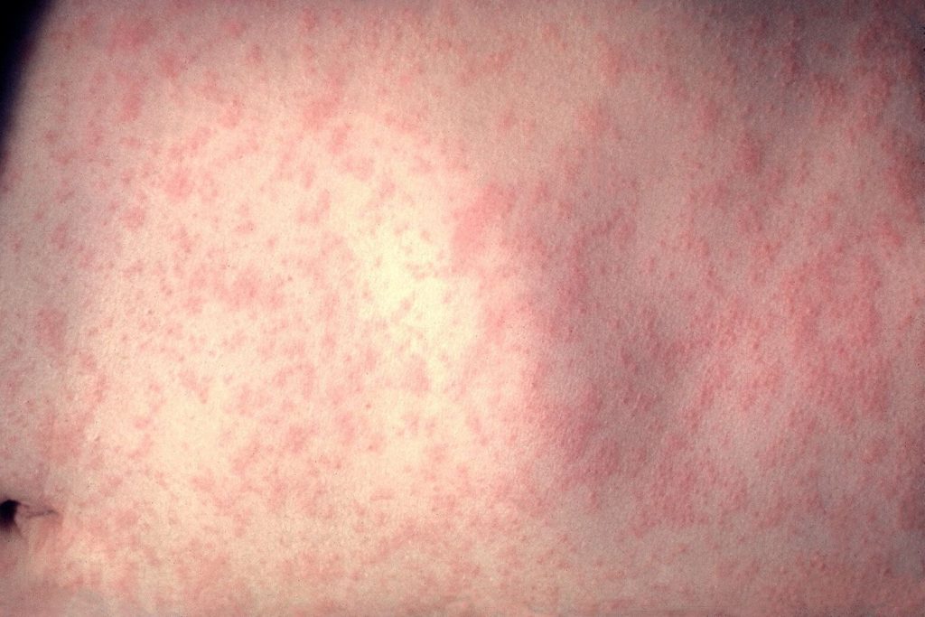 Single case of measles confirmed in DC area Cnn L19jb21wb25lbnrzl2ltywdll2luc3rhbmnlcy9jbhi2dgtwz3gwmdawm2i1d3pnywr4bnp5 L19jb21wb25lbnrzl2fydgljbguvaw5zdgfuy2vzl2nscjzud28wnzawmjm2nxbioguxyji0yxg 300 E1720879331292.jpg