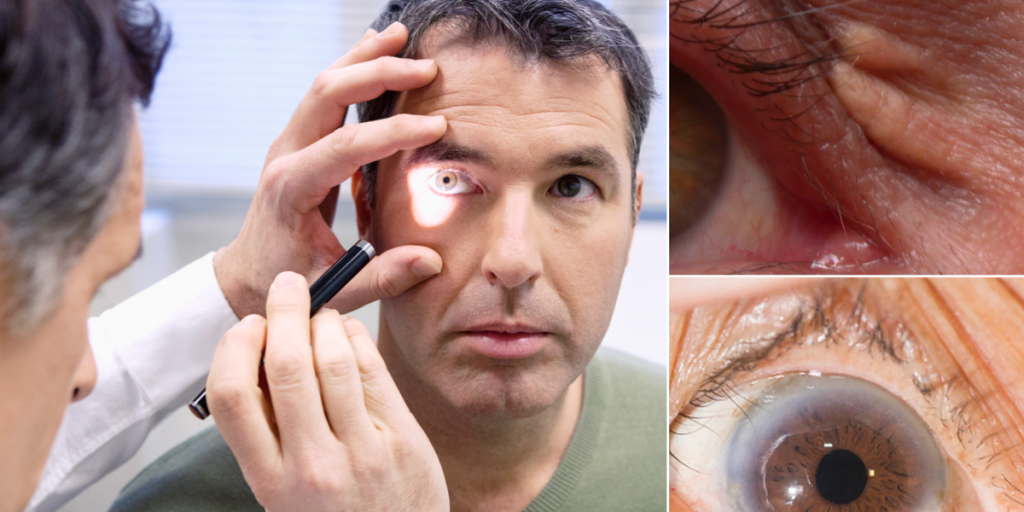 Doctor reveals symptom of high cholesterol on the face Composite Image Of A Doctor Studying A Person S Face And Clumps Of Cholesterol In And Around An Eye.png
