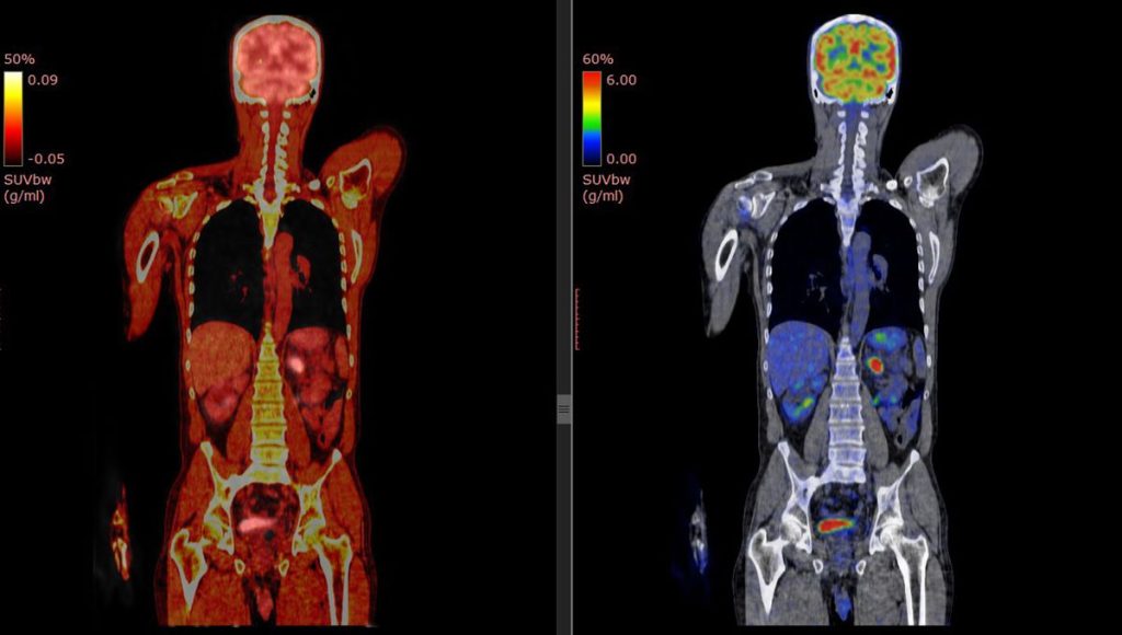 Pet Ct Scan Meta.jpg