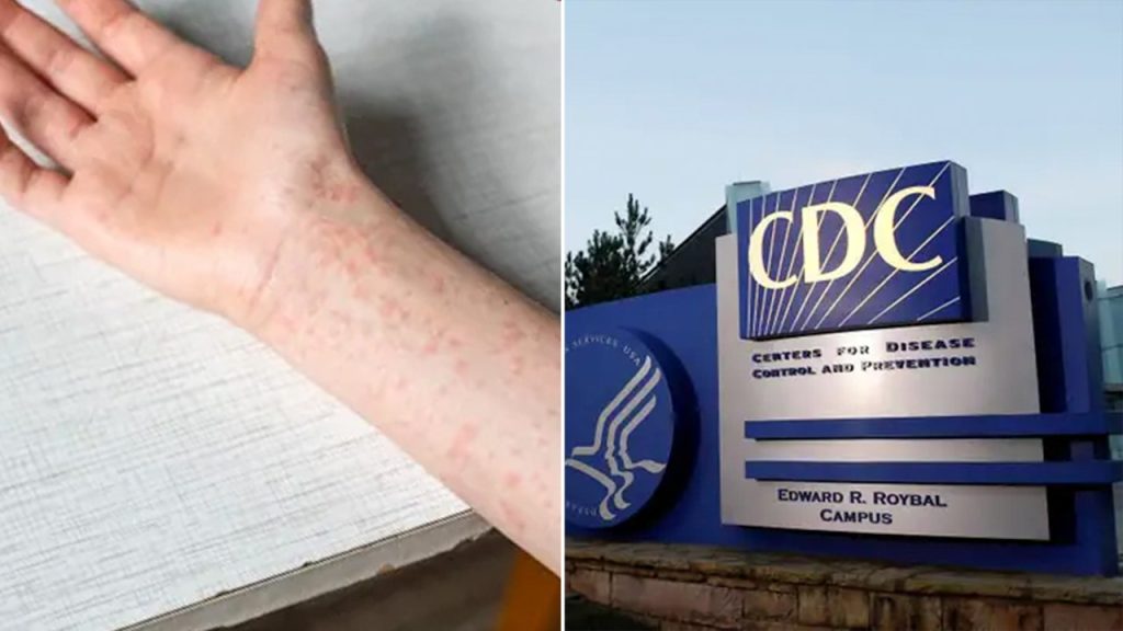 Texas’ measles outbreak explodes to 561 cases Cdc Measles.jpg